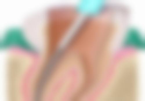 抗生素疗法：根尖周炎除根管治疗外辅助治疗的好帮手