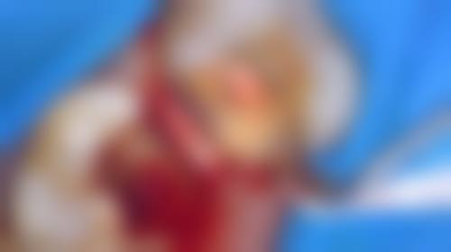 牙髓血运重建术：根尖周炎除根管治疗外年轻恒牙的福音