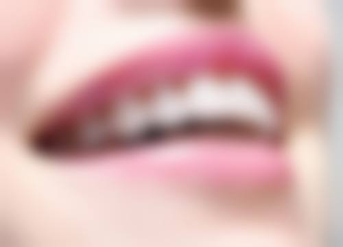 英德爱雅仕口腔诊所真实实例：见证神奇的口腔蜕变