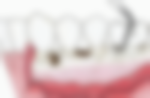 南通中诺口腔4岁小孩牙齿地包天矫正时间合适靠谱吗