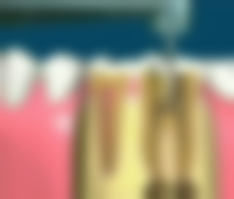 重新补牙解决侧面补牙容易掉的问题靠谱吗？