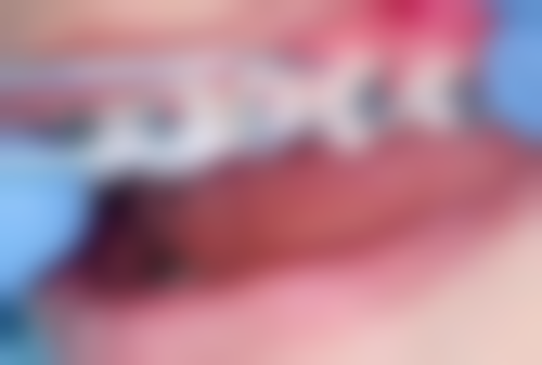 烤瓷牙和种植牙哪个更好？一文揭秘两者优缺点、适用人群及费用差异，助你选对修复方式！ 