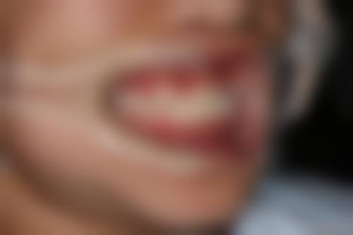 温州瑞安阿锚口腔真实实例：见证牙齿蜕变奇迹