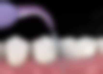 拔牙可以立马种牙吗？揭秘口腔医学新趋势，种牙时机这3大关键因素你知晓几个？ 