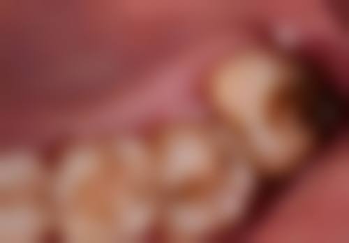 牙齿根管治疗一定要带牙冠吗？揭秘3大必带原因，让你告别牙齿隐患，重绽健康笑容！ 