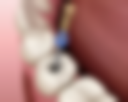 护理不当会导致烤瓷牙变黑吗