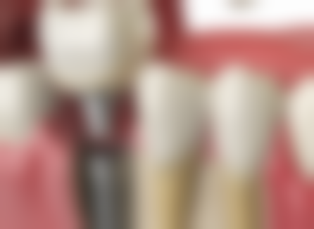 烤瓷牙变黑了是什么原因？是材料问题、口腔环境影响还是护理不当？一文带你揭秘真相！ 