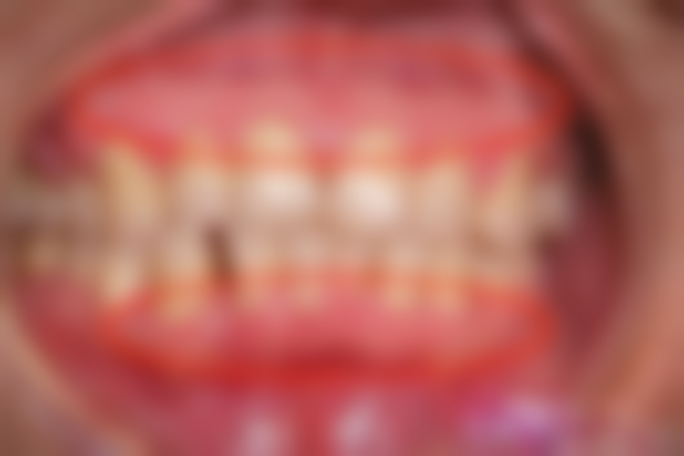 经期拔牙愈合延迟值不值