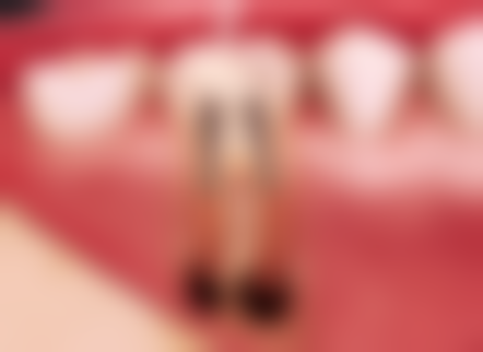 补牙要在大姨妈走后多久？了解3 - 7天的科学依据，避免经期补牙风险，让你的牙齿修复更安心！ 