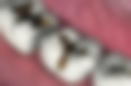 不同体质的人补牙垫底后多久补牙适合吗？