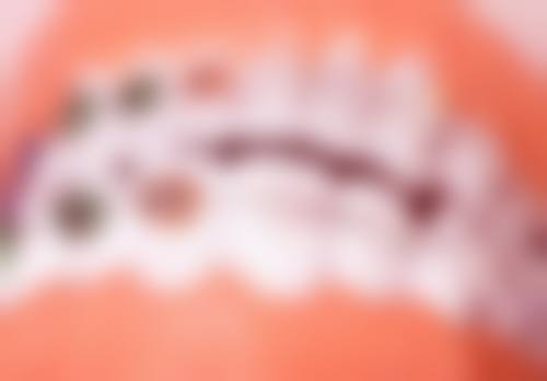 惠州精英惠口腔门诊部根管治疗后用硬毛牙刷刷牙靠谱吗？