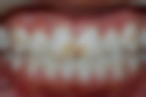 拉瓦全瓷牙哪个国家的？揭秘其原产国，了解这 3 大优势，助你轻松拥有健康美牙！ 