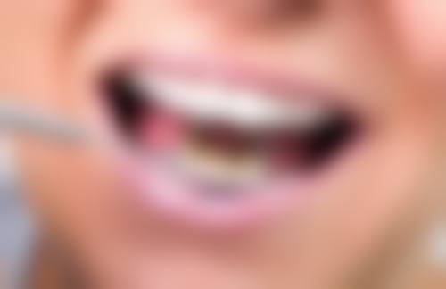 补牙用好的材料在ZZ眼科医院靠谱吗