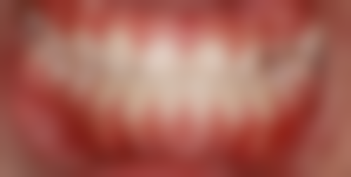 北京圣嘉新医疗美容医院矫正骨性地包天怎么样?