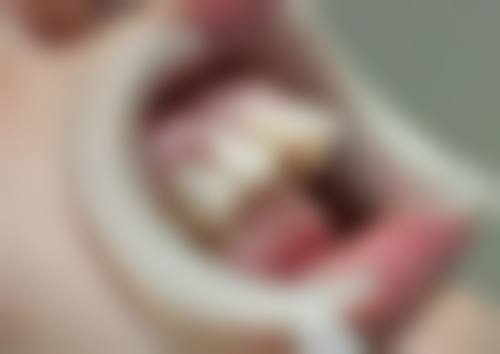 乳牙地包天如何矫正？掌握这5大科学矫正方法，让孩子告别地包天，绽放自信笑容！ 