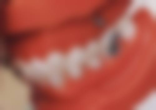 根管治疗后保持口腔卫生，对牙齿修复有帮助吗？