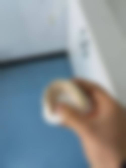 江苏苏州昆山宏成口腔真实实例：见证治疗成效