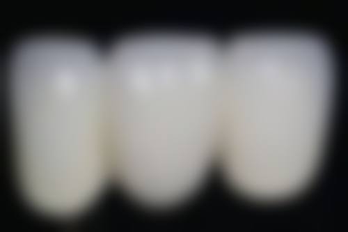 全瓷和烤瓷牙冠在影像学检查上的区别重要吗?