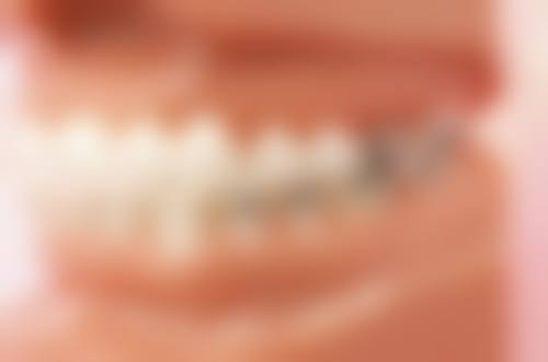 全瓷和烤瓷牙冠在美观度上的区别怎么样?