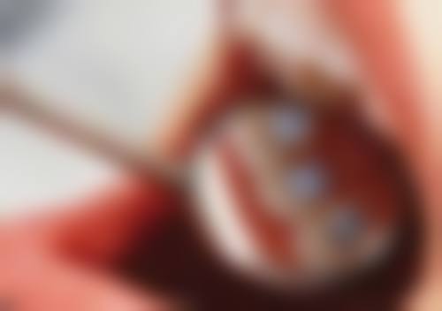 惠州精英惠口腔江北院区地包天矫正到什么程度摘牙套合适？