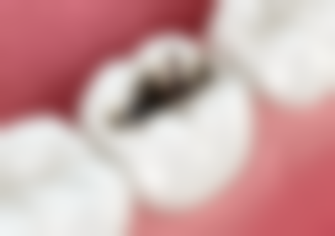 洗牙前后要注意什么？牢记这 5 大要点，让你洗牙后口腔健康加倍，远离 3 种常见隐患！ 