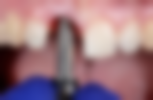 西安莲湖恒雅口腔诊所真实实例：见证神奇改变