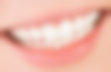 如何自己纠正地包天？掌握这5个实用方法，不用手术也能改善！轻松拥有完美口腔咬合！ 