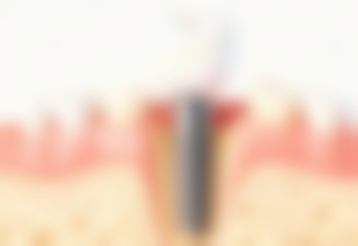 北京加减美医疗美容认为拔牙后吃什么好修复靠谱吗？