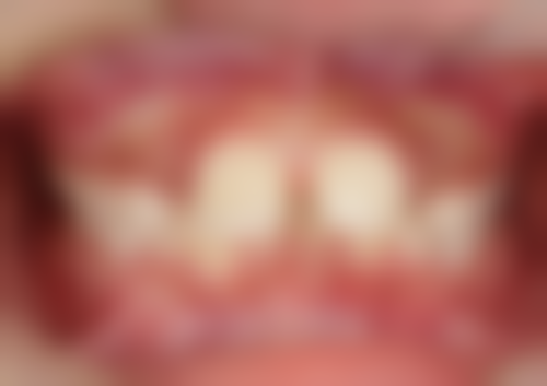 全瓷牙牙龈发黑是材料问题吗