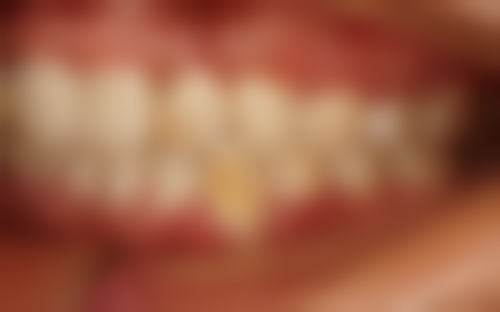 金属牙冠和烤瓷牙冠有什么区别？从材质、价格、美观度等 5 大方面为你剖析，看完不再纠结选哪个！ 