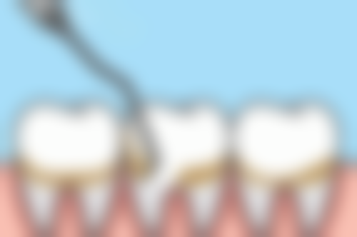 一岁两个月孩子地包天纠正后会复发吗