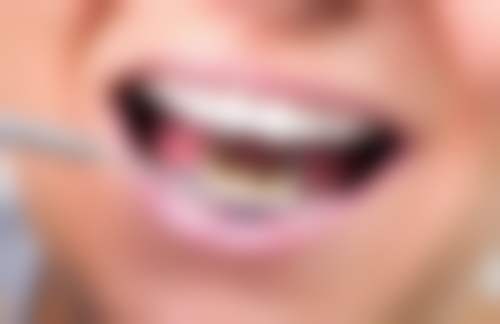 拔牙后3个月半口种植牙齿靠谱吗