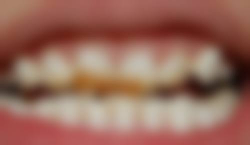 定期监测地包天矫正进展有必要吗？