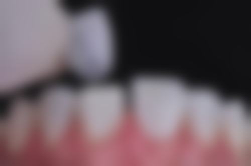 来大姨妈洗牙会影响洗牙成效吗