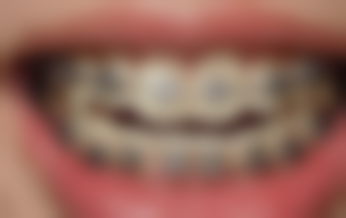 换牙期间矫正地包天适合吗