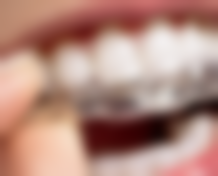 前牙地包天矫正时间受年龄影响怎么样