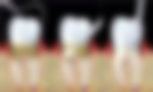 戴了牙冠还能做根管治疗吗？权威解答：能！解析戴牙冠后根管治疗流程、效果及注意事项！ 