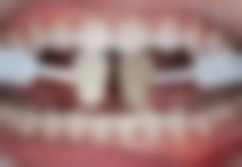 小孩牙齿地包天不矫正对成长发育有什么影响