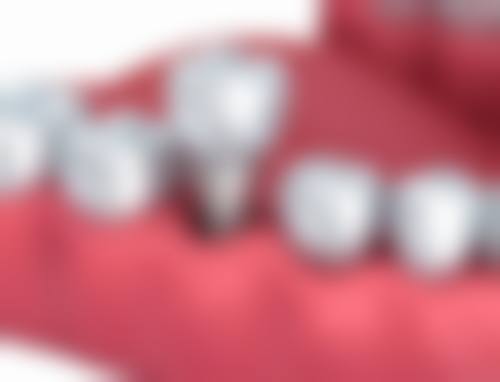 中山港口松鼠口腔医院真实实例