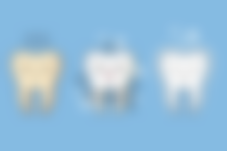 牙医说的根管治疗是什么意思？其实就是清除感染牙髓、消毒根管并填充，有效治疗牙髓炎、根尖周炎！ 