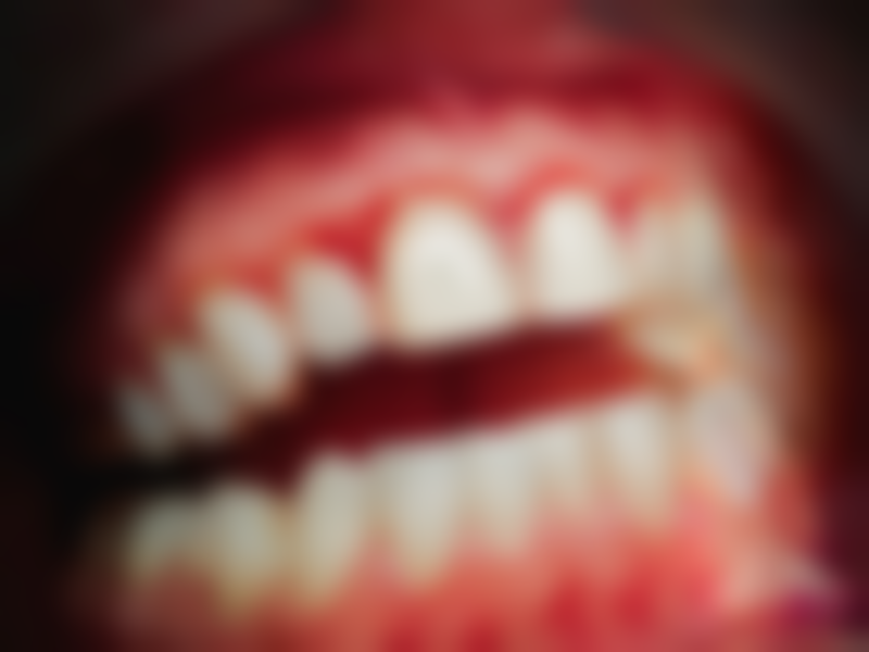 河南南阳方城万超口腔诊所陈旭做冷光美白牙手术成效好吗