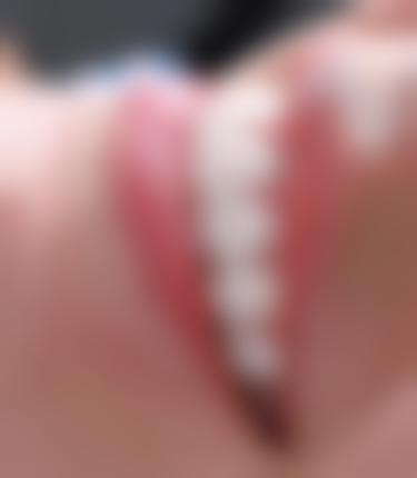 如何确定拔牙后更晚半年到一年是否适合种植牙