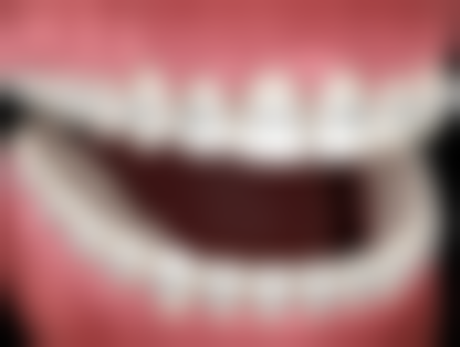 牙齿只有一个小洞需要根管治疗吗？答案来了，小洞情况不同，是否根管治疗看这3个关键因素 ！ 