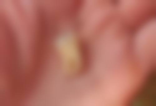 牙齿矫正要拔牙4颗老了有影响吗？权威解答：正常矫正拔牙对老年牙齿健康无明显不良影响！ 