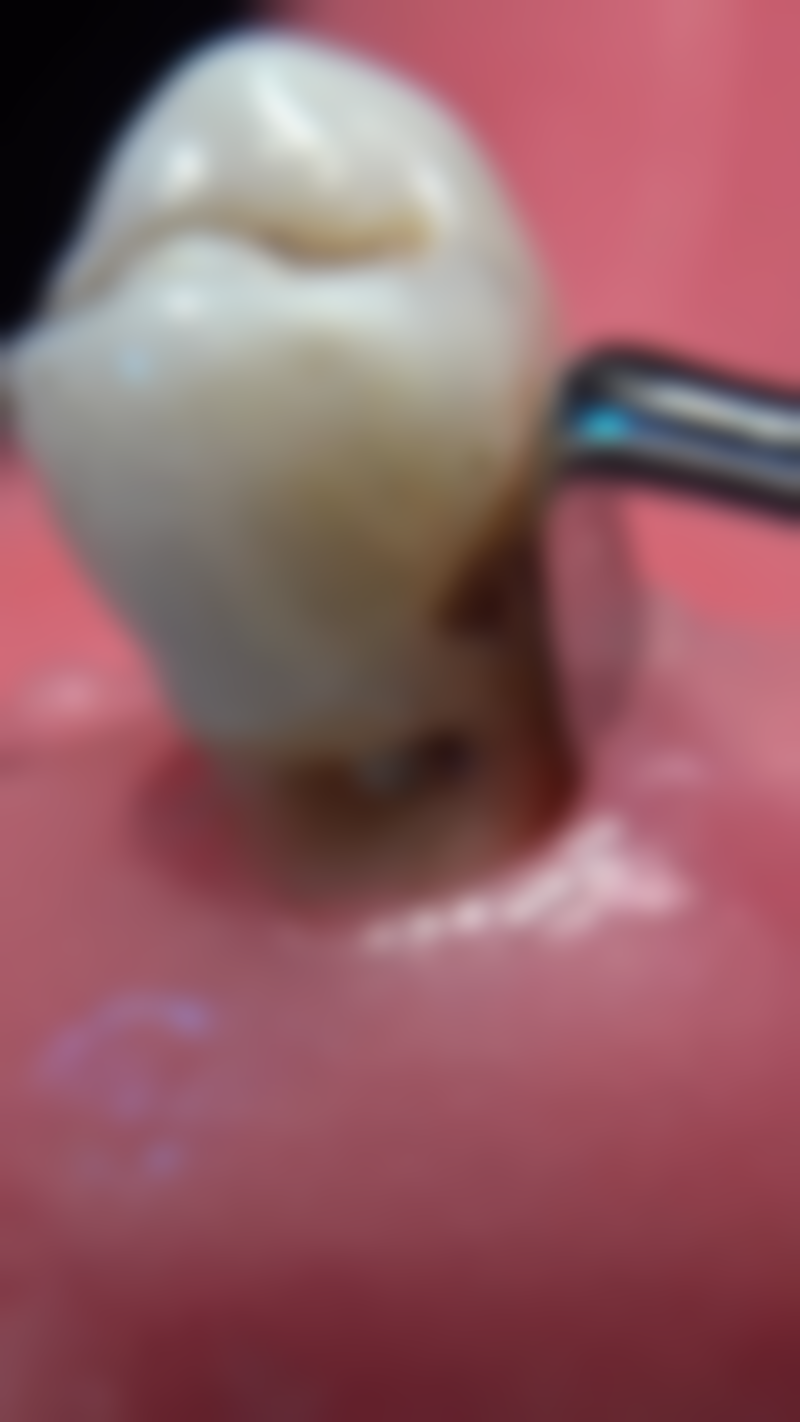 经期前一两天可以拔牙吗？权威解答：经期前一两天尽量别拔牙，或增出血感染风险！ 