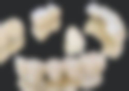 牙齿掉了一块做根管治疗值不值