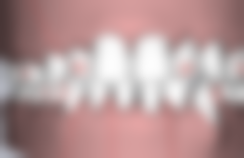 补牙后两牙之间有缝隙怎么办？别慌！掌握这 3 种有效修复方法，让牙齿无缝贴合！ 