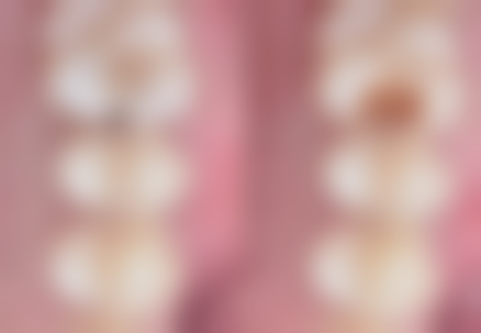 玻璃补牙后过早正常进食会有什么后果