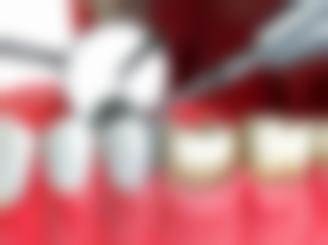 拔牙后多久能喝可乐？专家揭秘：一般拔牙24小时后，创口初步凝血便可少量饮用！ 