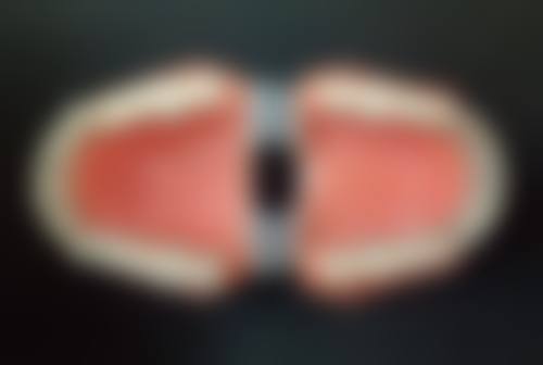 补牙后马上洗牙会怎么样